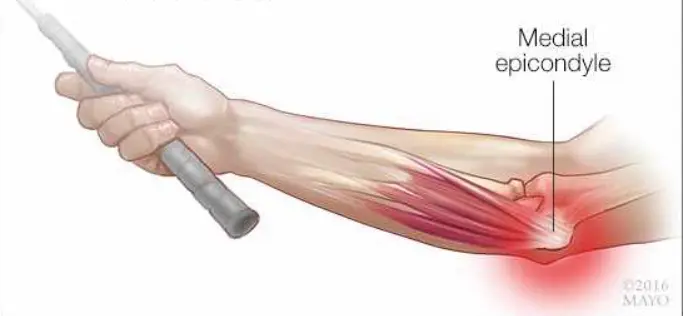 Epicondilalgia medial