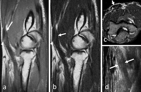 Tendinopatia de biceps o triceps braquial